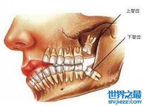 尽头牙是什么意思 智齿真的一定要拔出吗 