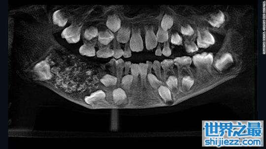 印度7岁男孩下颚肿胀,嘴里竟然多长了526颗牙齿 