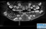印度7岁男孩下颚肿胀,嘴里竟然多长了526颗牙齿