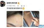 王思聪女友做饭被油烫伤！肌肤红润险些破相，拉开领口露胸前伤痕 ...