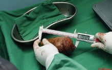 吉尼斯认证！斯里兰卡老兵腹痛开刀，取出801克“世界最大肾结石”