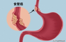 中国每年新增癌症患者307万，食道癌居世界之最！