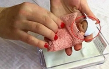 世上“最小的婴儿”，出生仅25厘米，比手掌还小，后来长大了吗？